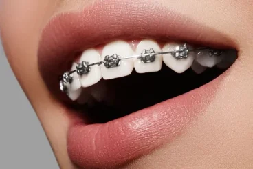 Understanding How Braces Facilitate Easier Dental Cleanings and Preventive Care